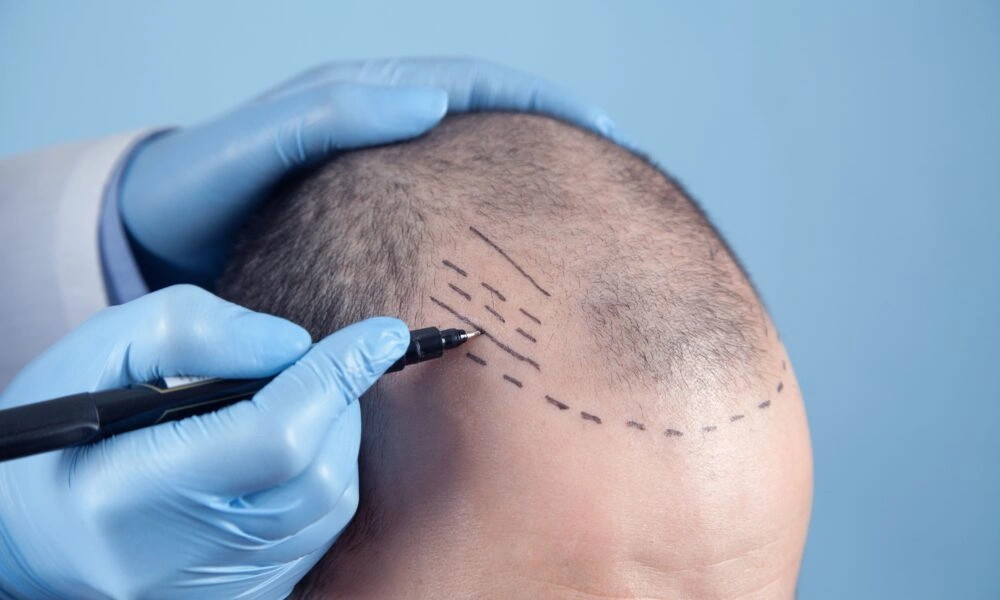 Hair Transplant Surgery